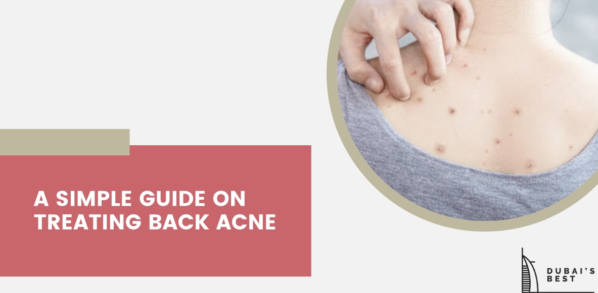 A Simple Guide on Treating Back Acne