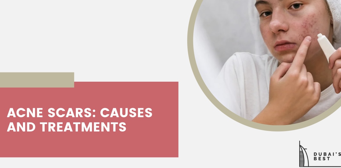 Acne Scars Causes and Treatments