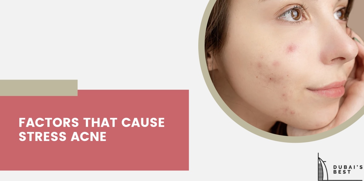 Factors That Cause Stress Acne