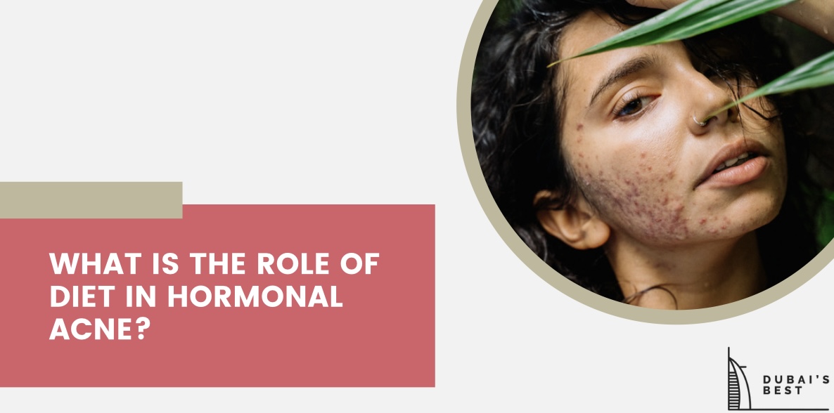 What is the role of diet in hormonal acne
