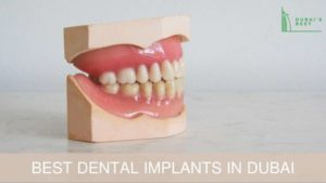 Dental Implants