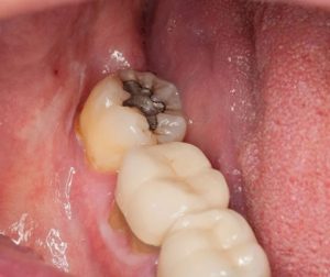 Fillings for Cavities