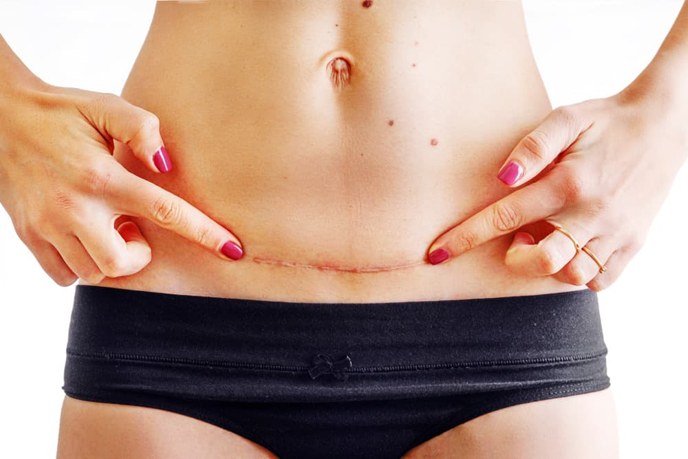 Abdominoplasty