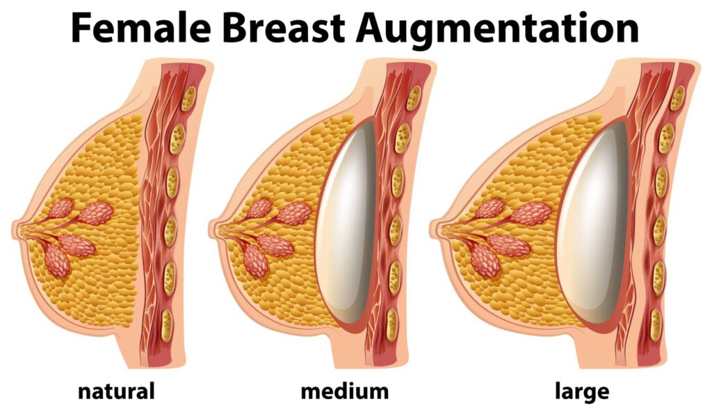 Breast Augmentation